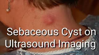 Ultrasound video Reveals Detailed Look Inside a Sebaceous Cyst [upl. by Naejeillib]