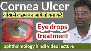 cornea ulcer treatment  cornea foreign body  corneal ulcer treatment  cornea ulcer eye drops [upl. by Nylatsirhc]