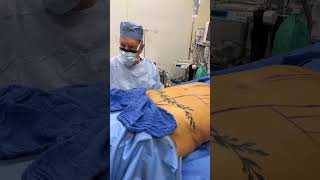 BLOODLESS HIGH DEFINITION LIPOSUCTION amp BBL BY DR GABRIEL PATINO 11 15 20245105257999 [upl. by Hgielsel340]