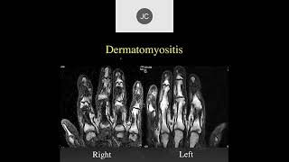 MRI of the Wrist Part 15  Wrist Inflammation [upl. by Nord]