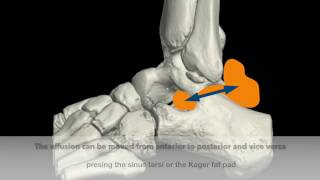 Ankle posterior subtalar joint effusion assessment [upl. by Gainor703]