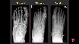 Tarsometatarsal Joints and Midfoot Lisfranc Sprains [upl. by Ettennor851]