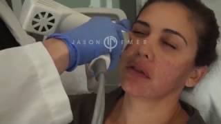 Syneron Profound Microneedling with Radiofrequency  Skin Facial Tightening and Lifting [upl. by Nyleahs265]