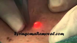 Syringoma removal using cosmetic lasers [upl. by Aneek]