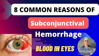 Blood in eyes  Subconjunctival Hemorrhage 8 Reasons and Treatment [upl. by Lleynad]