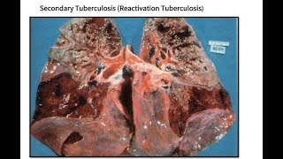 Morphology of Secondary Pulmonary Tuberculosis [upl. by Pierpont436]