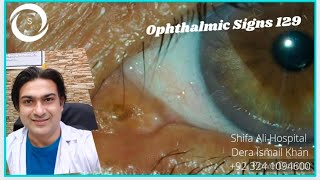 Ophthalmic Signs 129 [upl. by Mullac]