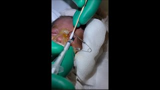 Retinopathy of Prematurity ROP Intravitreal Lucentis NICU [upl. by Shel5]