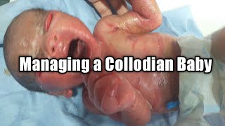 How to manage a Collodian Baby  Mothers Guide [upl. by Laurie]