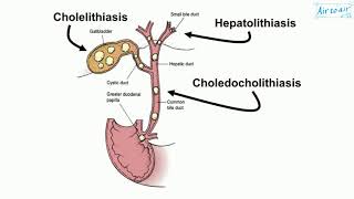 choledocholithiasis [upl. by Ibmat]