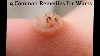 9 Common Remedies for Warts [upl. by Lavotsirc]