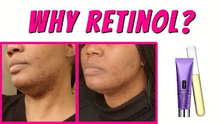 Is Retinol Good For Acne Scars  Retinol Review  Clinique Smart Clinical Night Retinol Cream [upl. by Ayalahs]