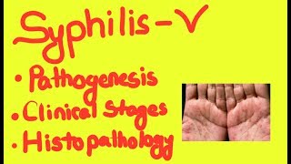 Syphillis Pathogenesis 2 Clinical Stages and Histopathology [upl. by Dallas]