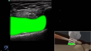 How to Ultrasound Guided Injection of the Medial Knee 3D Video [upl. by Milone978]