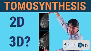 Tomosynthesis Does it offer 3D Mammography [upl. by Kendell]