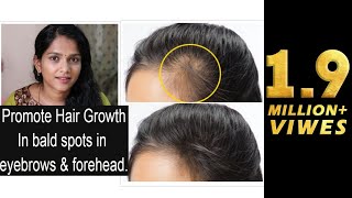 How to promote hair growth in bald areas like forehead amp eyebrows [upl. by Ennagrom]