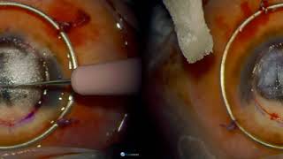 3D Surgery Deep Anterior Lamellar Keratoplasty DALK [upl. by Saffian]