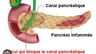 💥💣 Pancréatite aiguë 💥💣 [upl. by Niarbo]