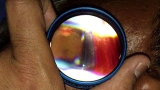 Indirect Ophthalmoscopy with Iphone [upl. by Aniral]