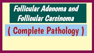 Follicular Adenoma And Follicular Carcinoma  Thyroid Neoplasm [upl. by Ehrman275]