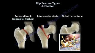 Hip Fracture Types amp Fixation  Everything You Need To Know  Dr Nabil Ebraheim [upl. by Suzanna]