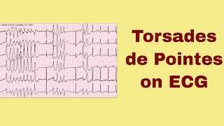 Torsade de Pointes on ECG [upl. by Amy]