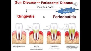 Gingivitis amp Periodontitis 22MarApr22 [upl. by Ynnahc]