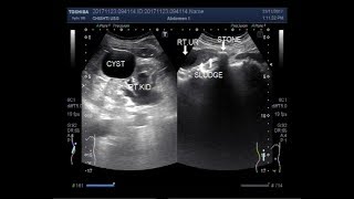 Ultrasound Video showing a simple renal cyst and stone amp sludge in ureter [upl. by Naylor691]