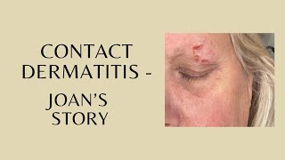 Contact Dermatitis  Joans Story [upl. by Rennat]