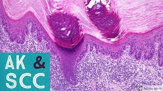 Squamous Cell Carcinoma amp Actinic Keratosis 101Dermpath Basics amp Beyond [upl. by Chilcote]