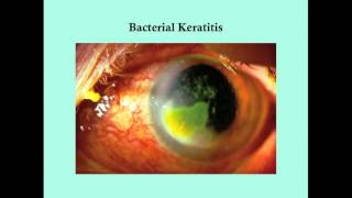 Keratitis  CRASH Medical Review Series [upl. by Eradis]