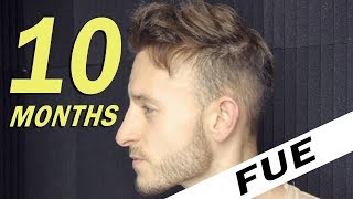 FUE Hair Transplant 10 Months post op Istanbul Turkey [upl. by Sherard296]