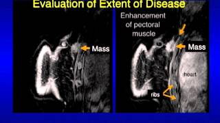 UCSF Radiology Mammography Images Revealing What Cancer Looks Like [upl. by Yerfej]