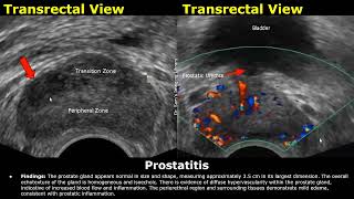 Prostate Ultrasound Reporting  BPHCancerCystCalcification Scan Reports  How To Write USG Report [upl. by Ahcsas]