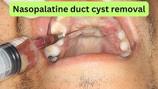 Nasopalatine duct cyst Removal anatomy and complications [upl. by Tutankhamen]