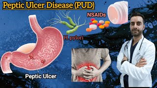 Peptic Ulcer Disease pathology  Peptic ulcer cause symptoms risk factors complication [upl. by Beka]