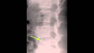 Burst Fracture L4 on X ray and CT [upl. by Fairman395]