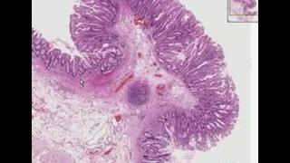 Histopathology ColonHyperplastic polyp [upl. by Halyahs]