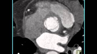 CardiacReimplantation of coronary artery following aortic root repair 5 of 5 [upl. by Anirbac]