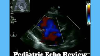 Hypoplastic Left Heart Syndrome [upl. by Gmur]