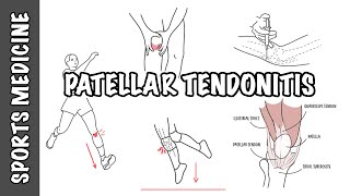 Patellar Tendonitis and Patellar Tendinopathy [upl. by Alim782]