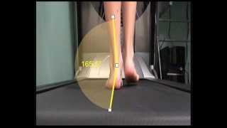 Over Pronation and how this is measured in walking [upl. by Linetta]