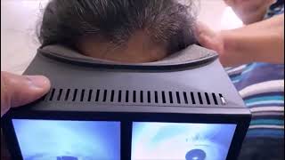 Multicanal BPPV with Canal Switch and Jam [upl. by Haidebez]