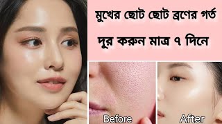 Home remedy to remove acne scars on face Natural ways to remove pimples scars on faceRemove pits [upl. by Kellyn84]