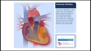 Ventricular Fibrillation Animation Video [upl. by Sirred]