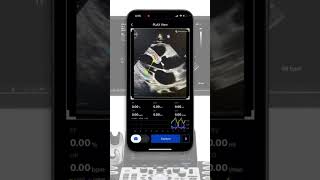 mobile Echocardiography AI solution [upl. by Singhal]