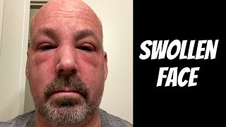 Swollen Face  Cancer Update [upl. by Montanez]