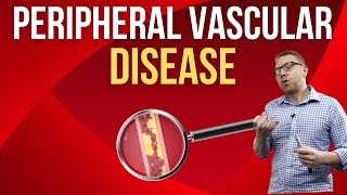 Peripheral Vascular Disease [upl. by Wiese602]