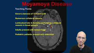 Moyamoya Disease [upl. by Orelia]