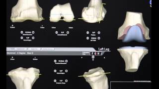 Total Knee Replacement Surgery  Patient Specific Implants PSI [upl. by Oneill]